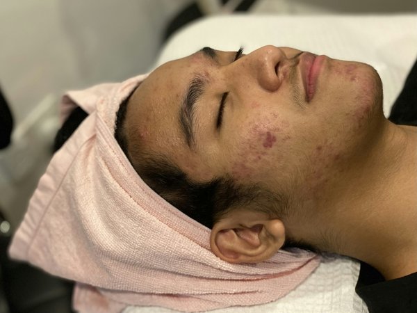 Quels sont les meilleurs traitements pour les peaux acnéiques utilisant de l'acide salicylique?